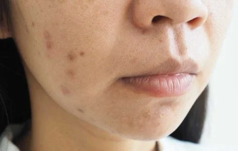 قهوه از بین بردن لکه های قهوه ای جای جوش روش خانگی