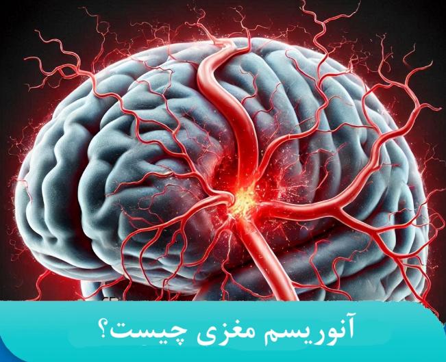 آیا آنوریسم مغزی درمان دارد؟