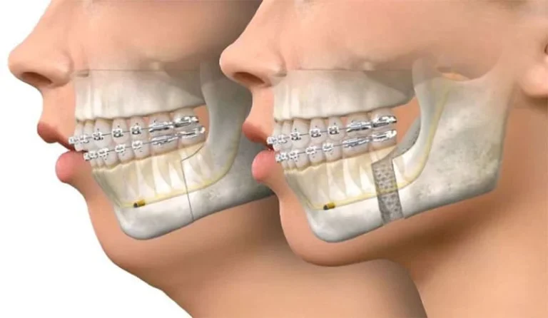 اول ارتودنسی انجام دهیم یا جراحی فک؟