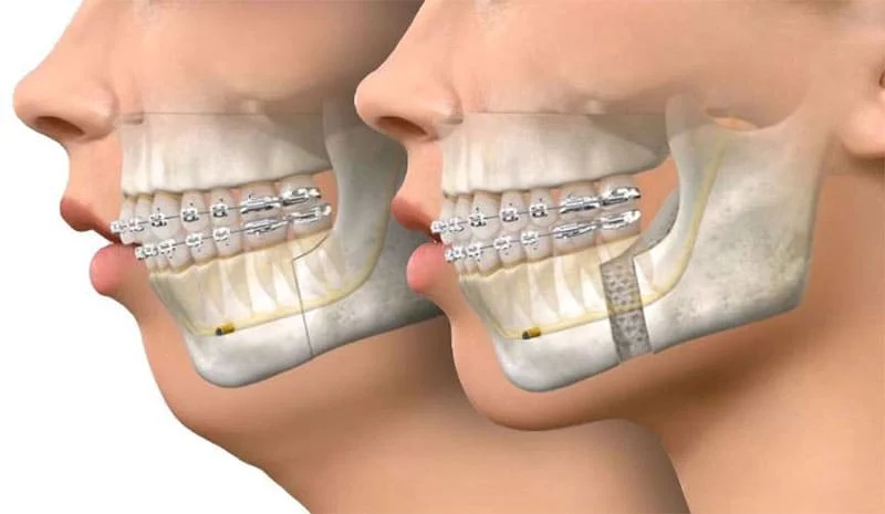 اول ارتودنسی انجام دهیم یا جراحی فک؟