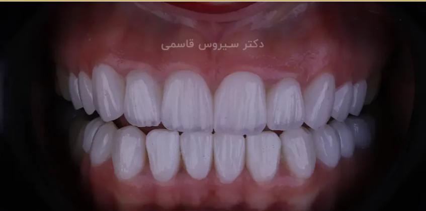دکتر سیروس قاسمی بهترین دکتر لمینت شیراز با بیش از 100 نمونه کار واقعی