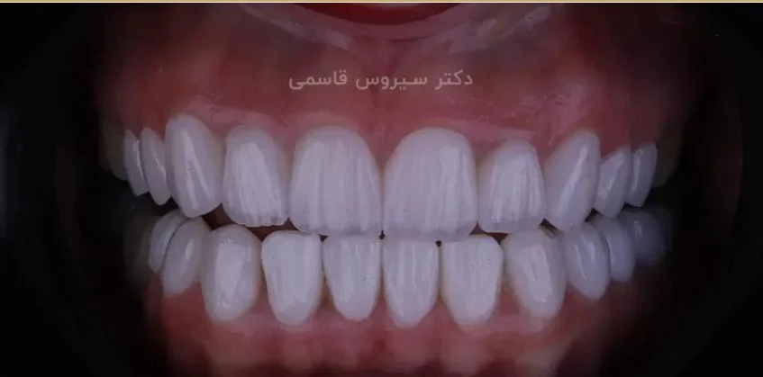 دکتر سیروس قاسمی بهترین دکتر لمینت شیراز با بیش از 100 نمونه کار واقعی