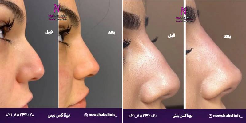 چرا بوتاکس بینی بهترین جایگزین جراحی زیبایی است؟