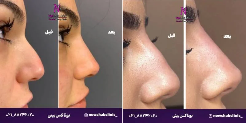 چرا بوتاکس بینی بهترین جایگزین جراحی زیبایی است؟
